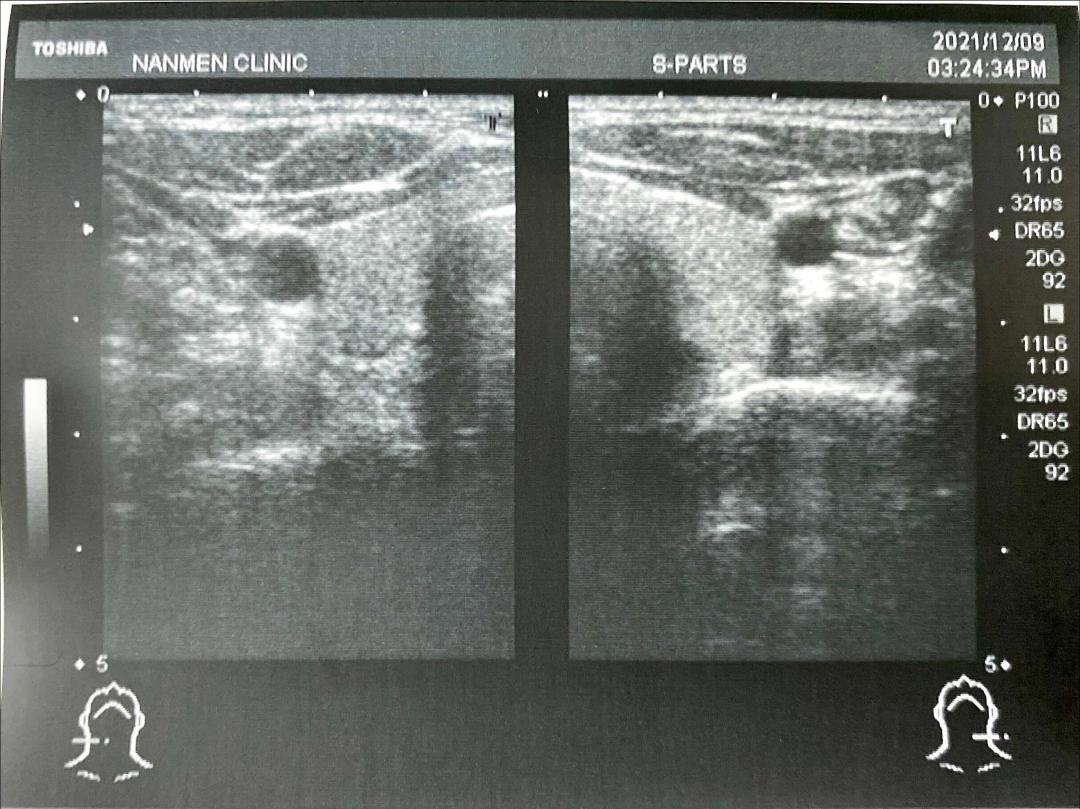 甲狀腺超音波