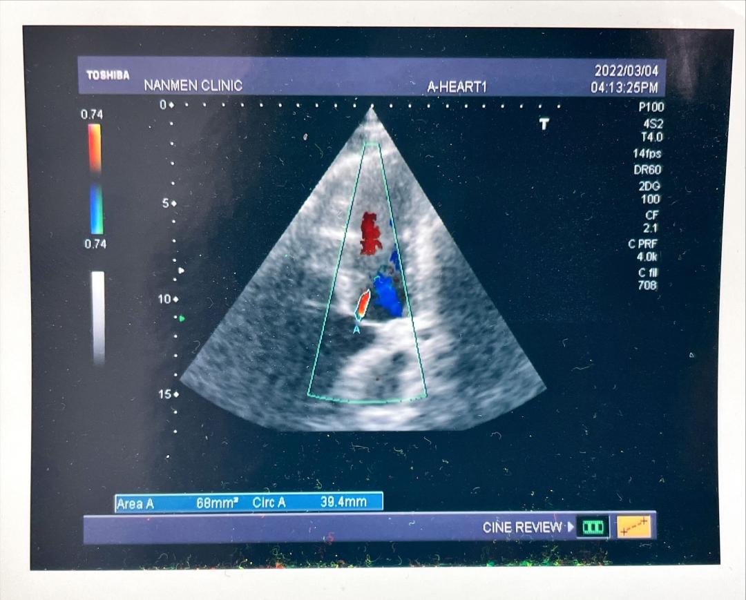 心臟超音波