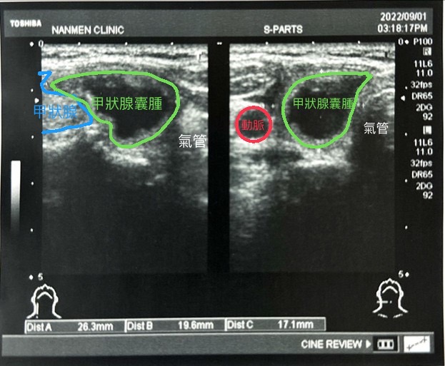 反覆發生的甲狀腺囊腫