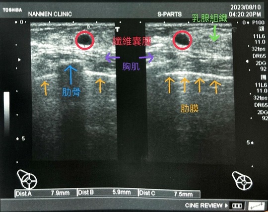 乳房硬塊--乳房纖維囊腫